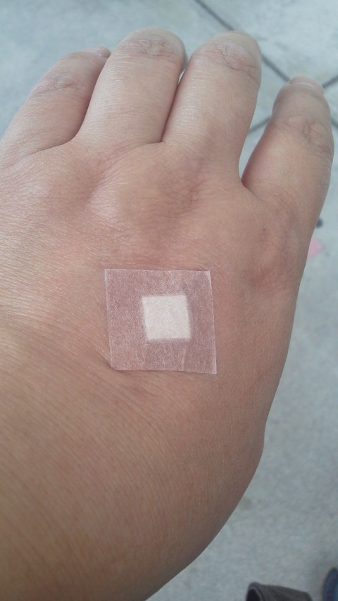 点滴を受けた後の手